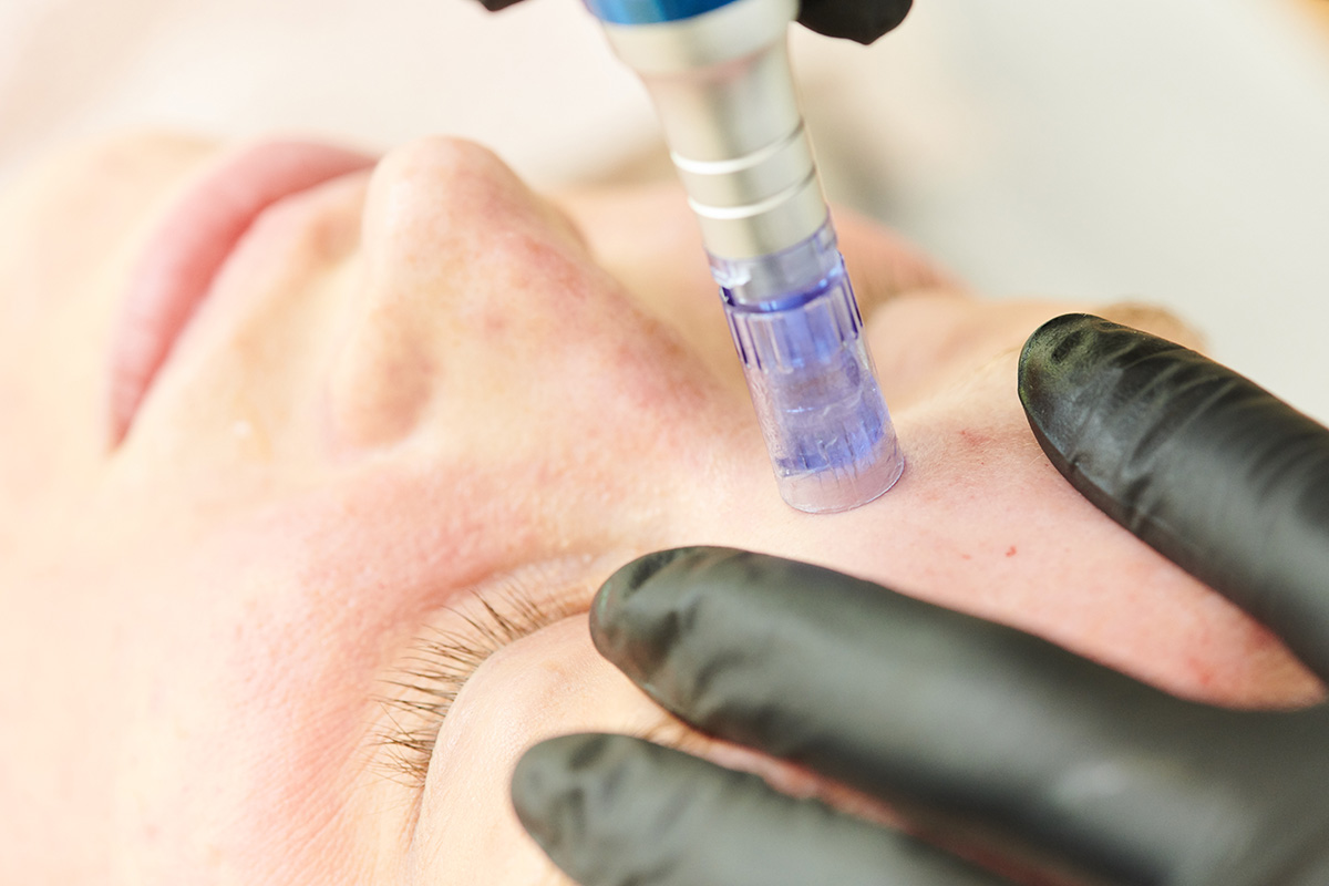 needlingsaarlandsaarbrückenmicroneedlingbehandlungphilingsneedeln