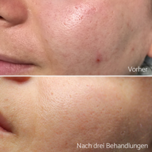 Microneedling Die Wunderwaffe Fur Glatte Porentief Reine Und Jugendliche Haut