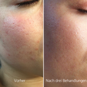 Microneedling Die Wunderwaffe Fur Glatte Porentief Reine Und Jugendliche Haut