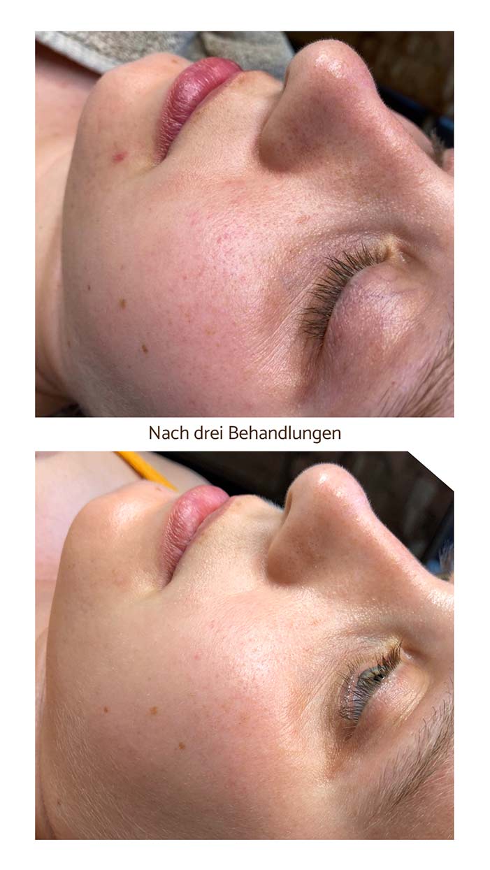 Microneedling Kosmetik im Saarland 