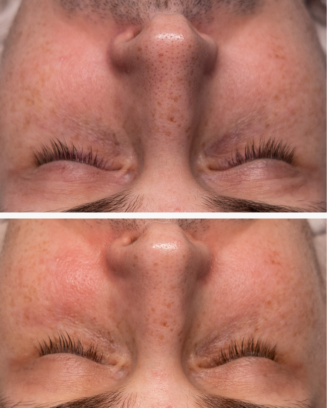 Vorher-Nachher Bild Vorher verstopfte Poren, nachher saubere, gesunde Haut